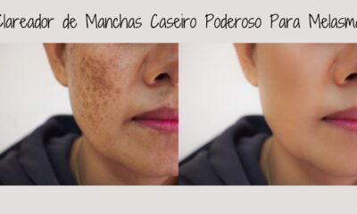 Clareador de Manchas Caseiro Poderoso Para Melasma