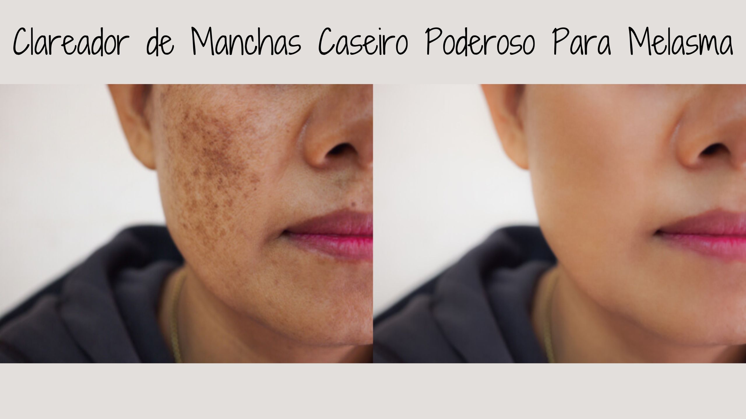 Clareador de Manchas Caseiro Poderoso Para Melasma